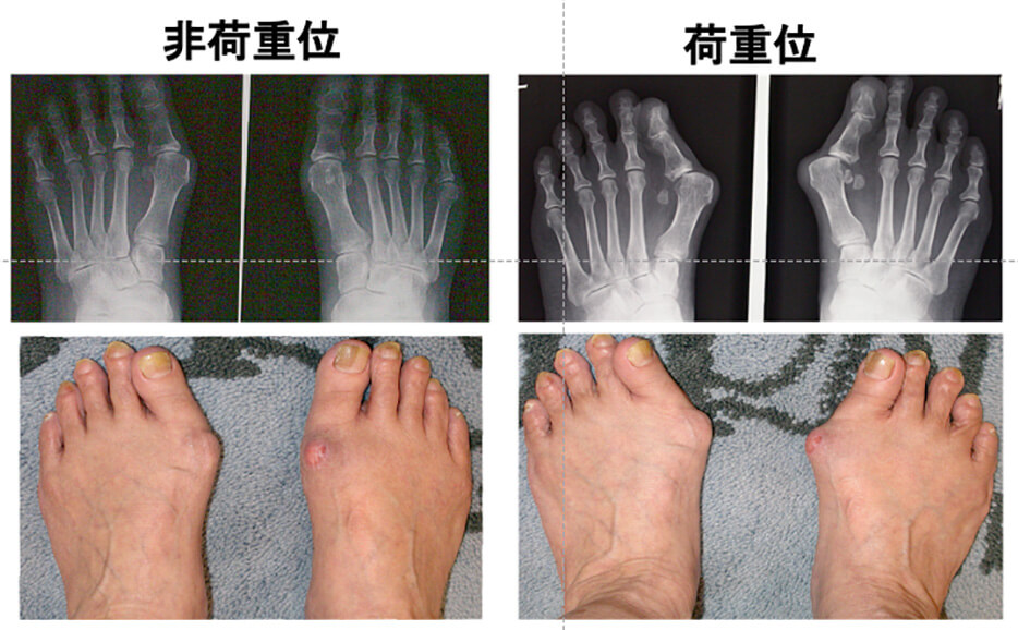 名医 外反母趾 手術 【2022年】東京都の外反母趾治療 おすすめしたい6医院