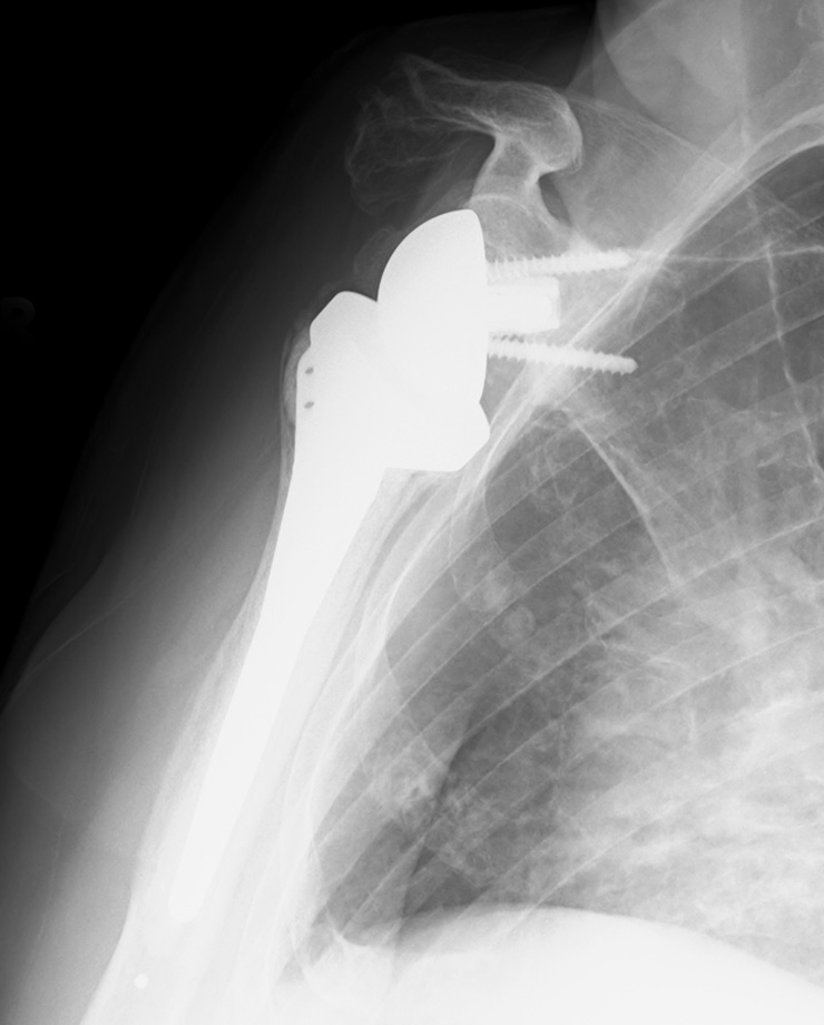 リバース型人工肩関節全置換術