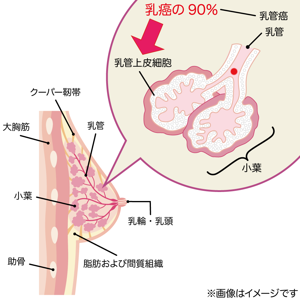 乳癌の病態