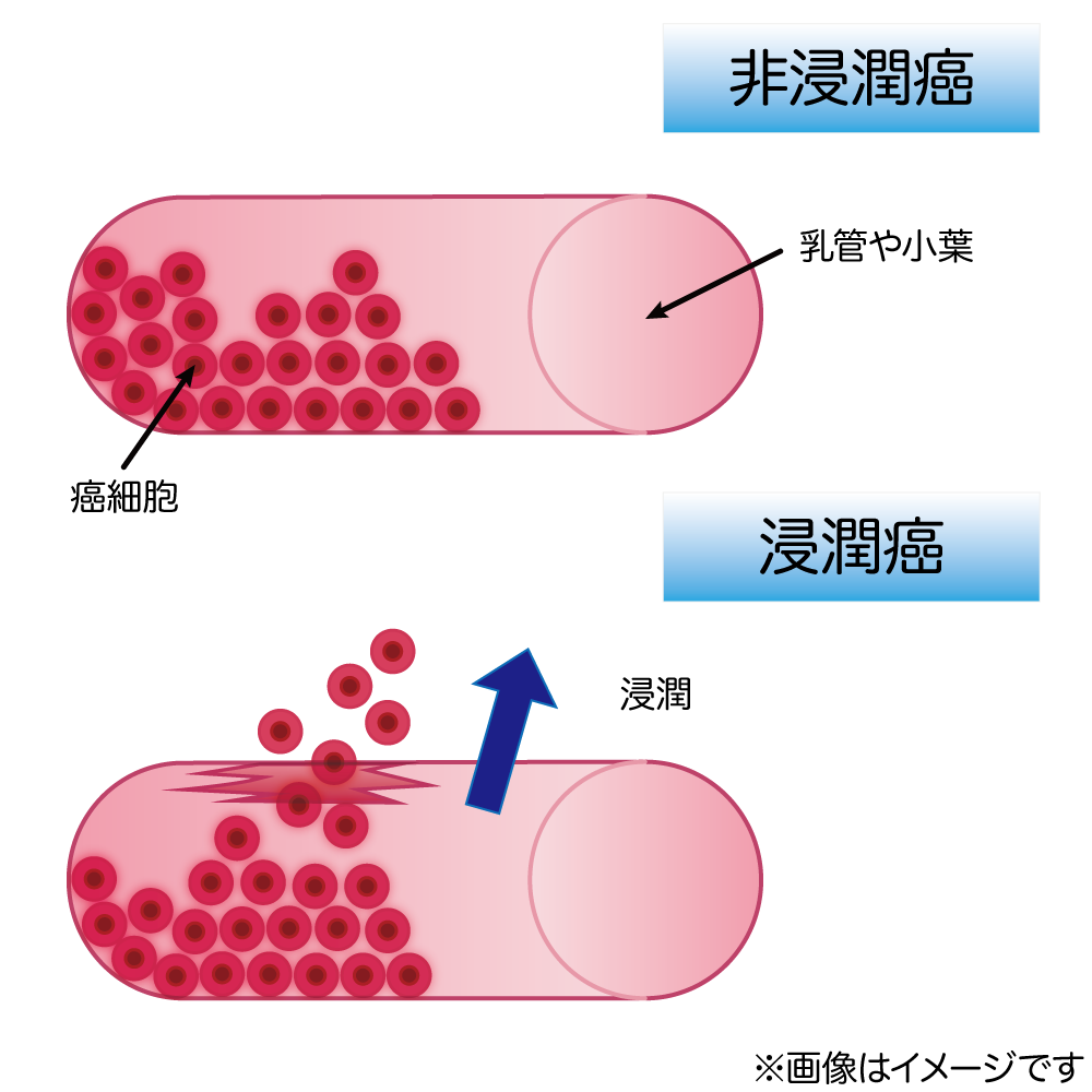 乳癌の進展・浸潤癌・非浸潤癌