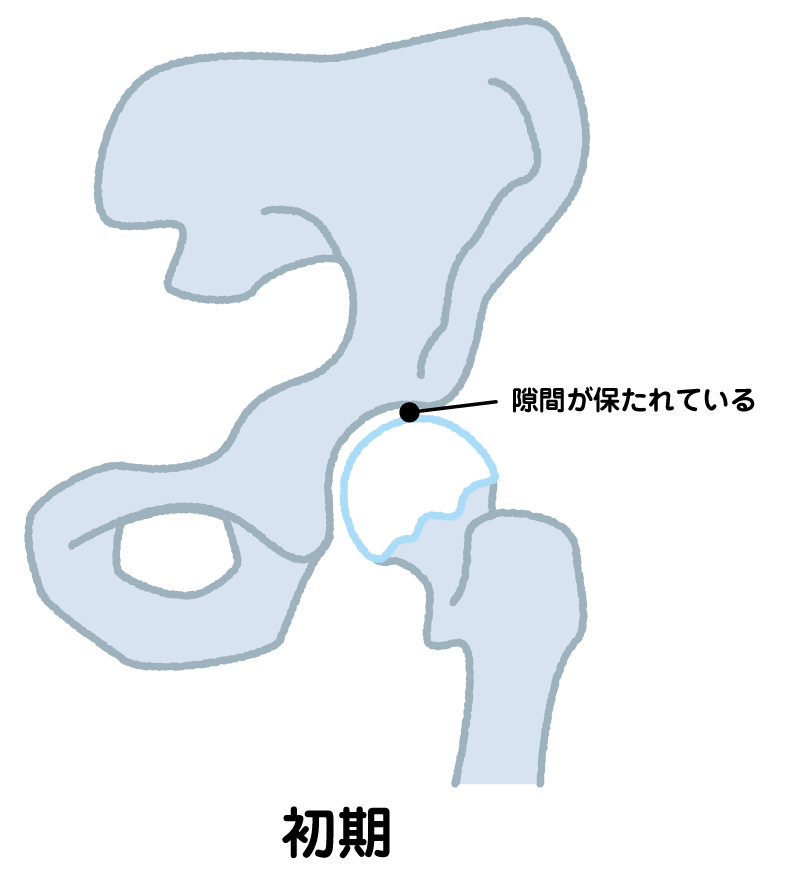 変形性股関節症　初期