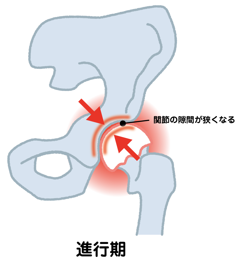 変形性股関節症　進行期