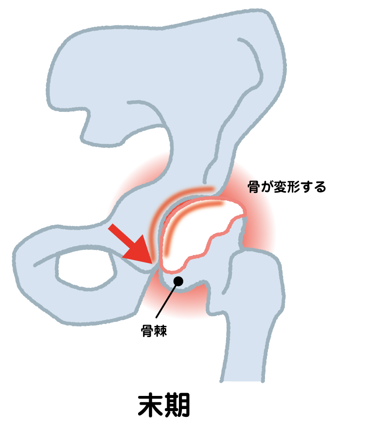 変形性股関節症　末期