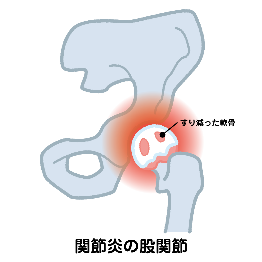 変形性股関節症