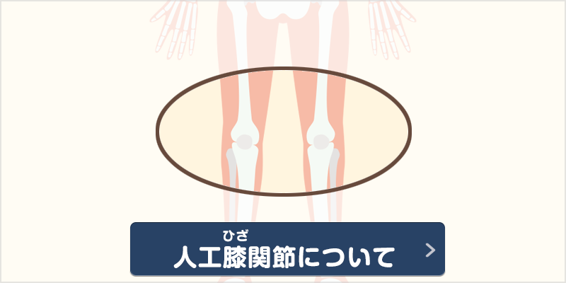 人工膝関節について