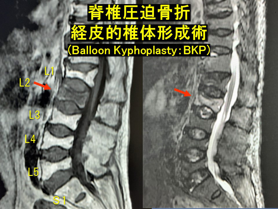 経皮的椎体形成術