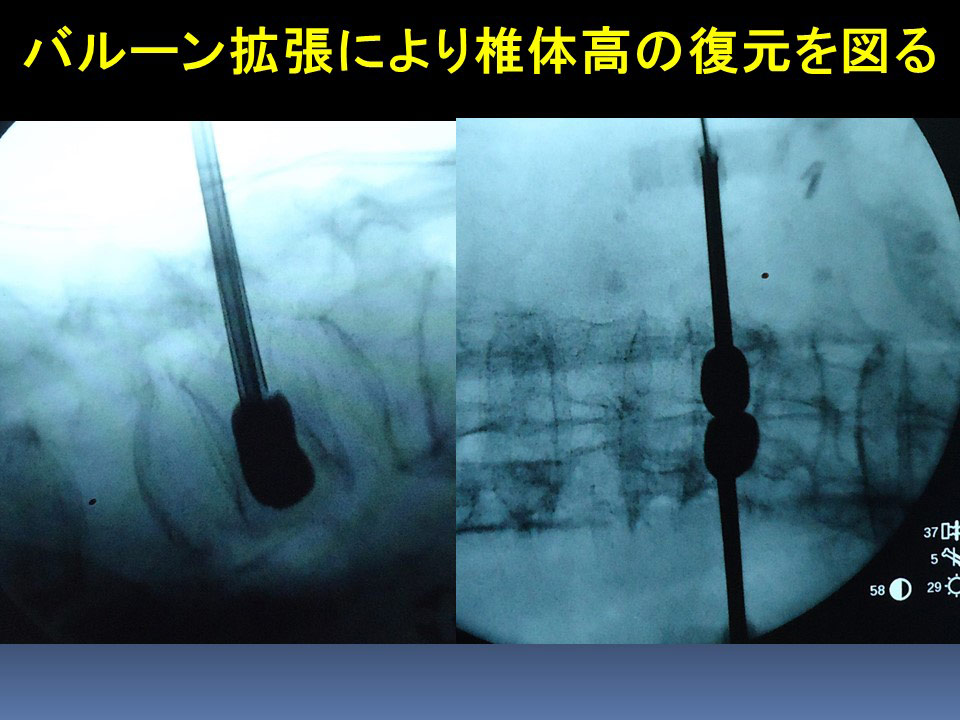 経皮的椎体形成術