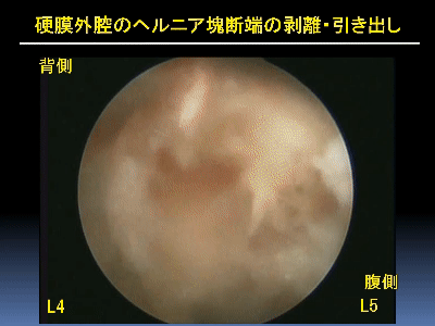 硬膜外腔ヘルニア塊断端の剥離・引き出し