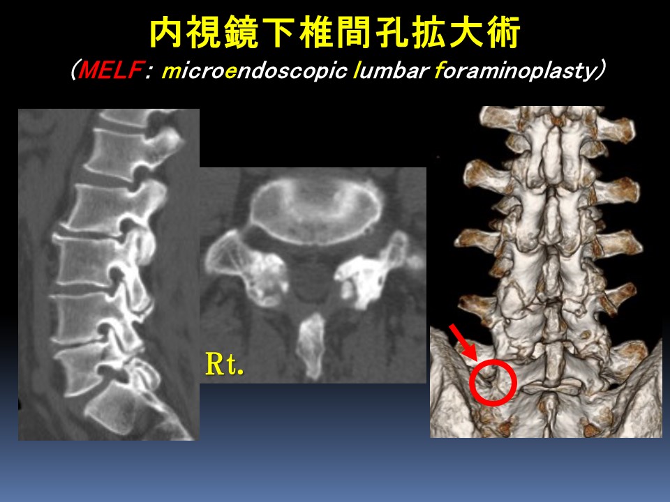 内視鏡下椎間孔拡大術