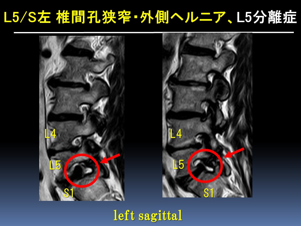 内視鏡下椎間孔拡大術