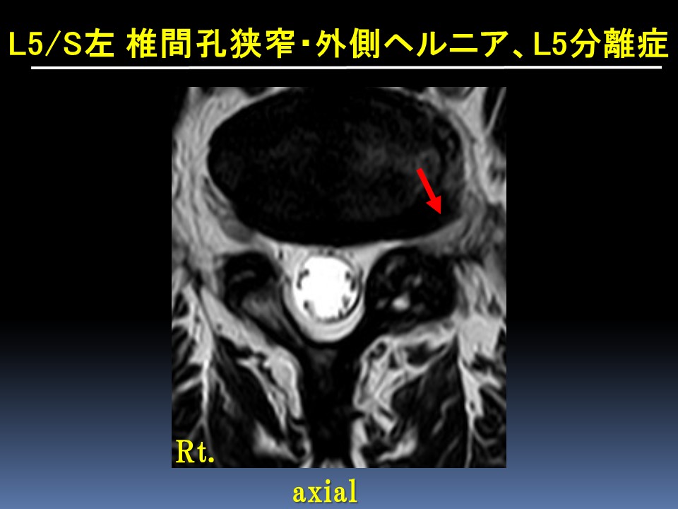 内視鏡下椎間孔拡大術