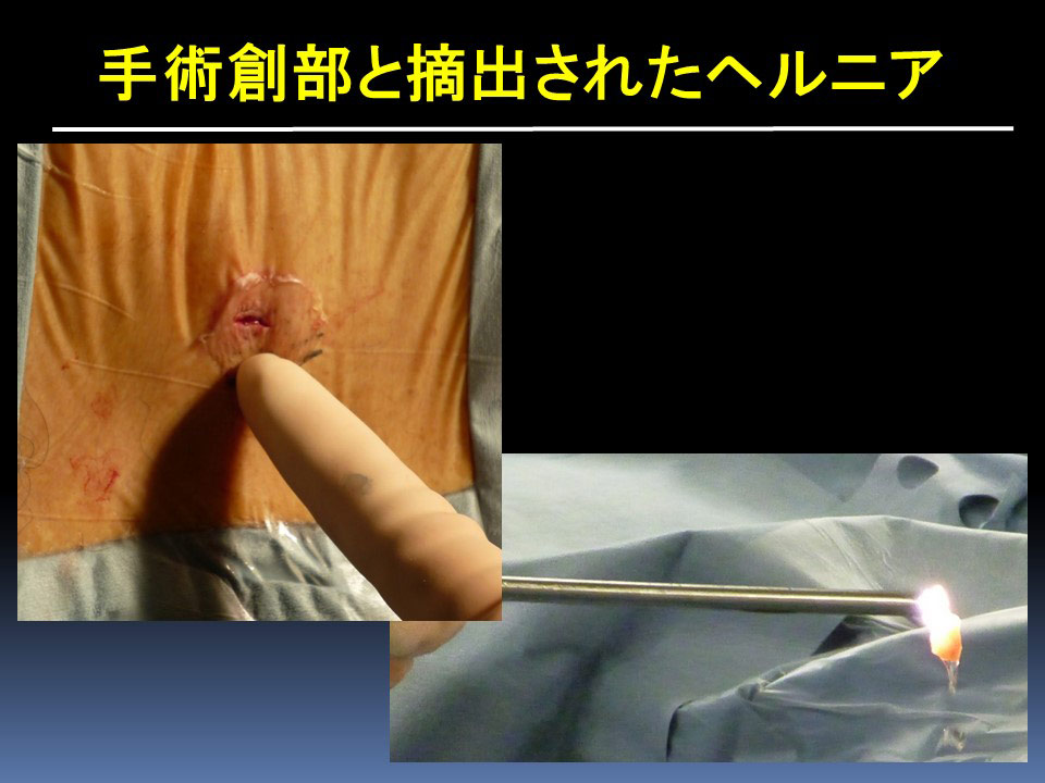 手術創部と摘出されたヘルニア