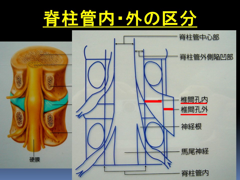 経皮的内視鏡下椎間孔拡大術