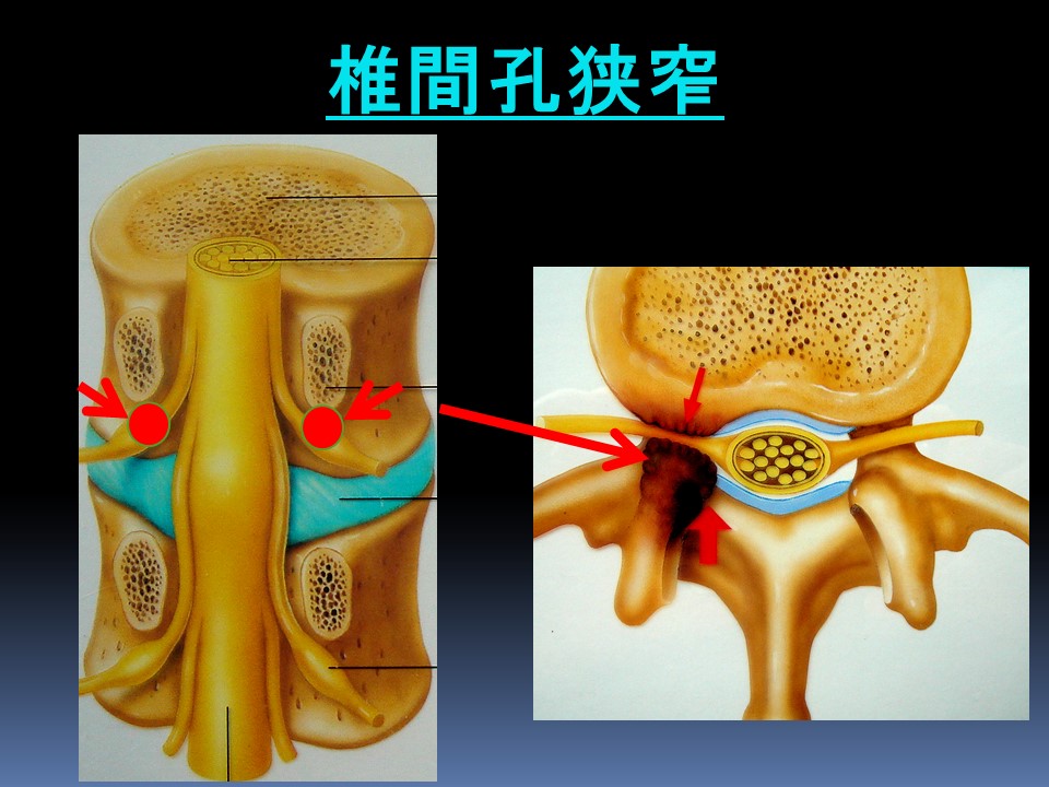 経皮的内視鏡下椎間孔拡大術