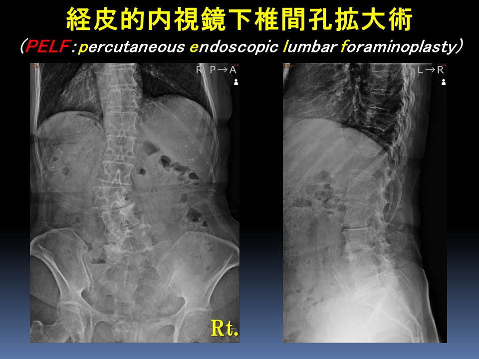 経皮的内視鏡下椎間孔拡大術