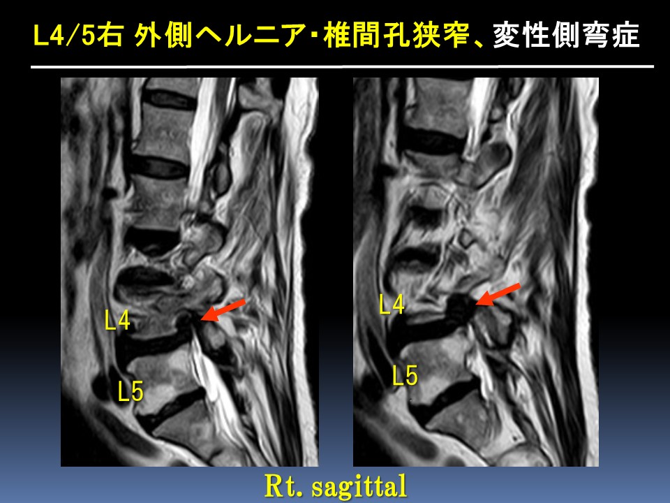 経皮的内視鏡下椎間孔拡大術