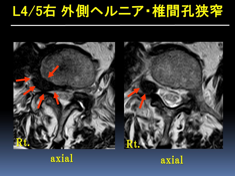 経皮的内視鏡下椎間孔拡大術