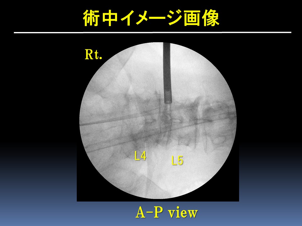 経皮的内視鏡下椎間孔拡大術