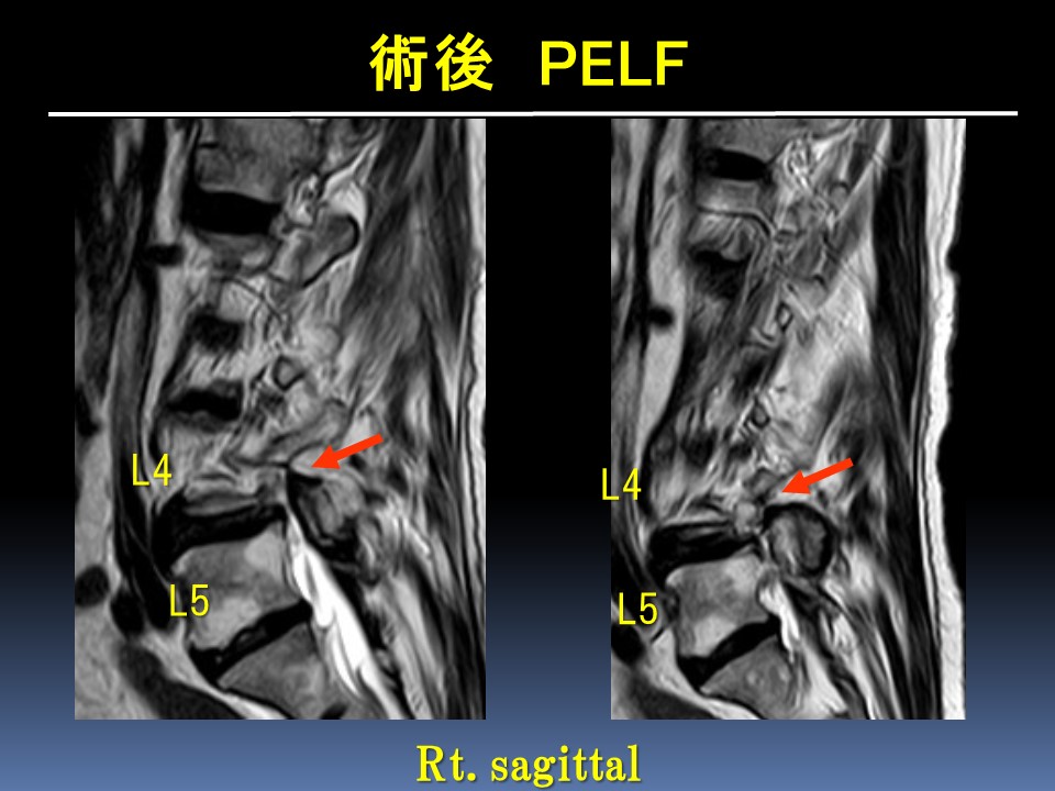 経皮的内視鏡下椎間孔拡大術