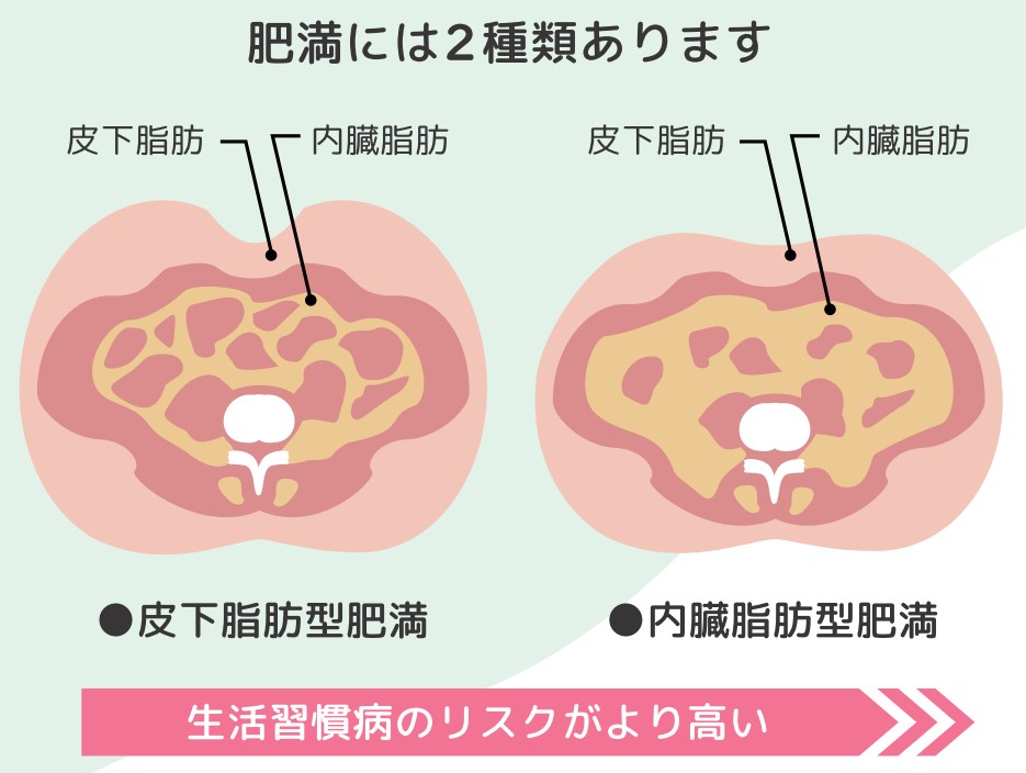 肥満には2種類あります